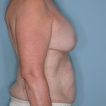 Implant Exchange Lift Before & After Patient #651