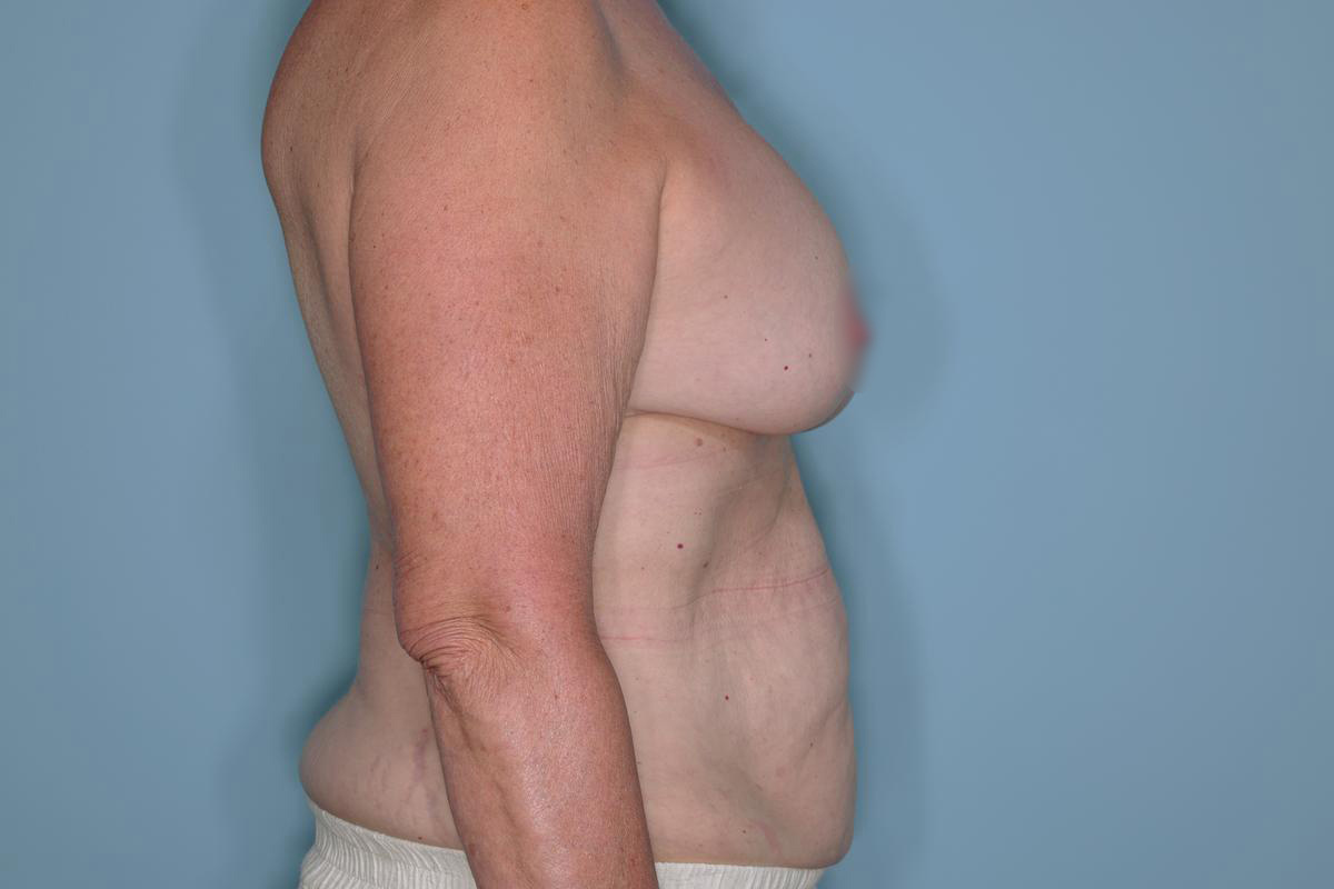 Implant Exchange Lift Before & After Patient #651