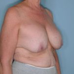 Implant Exchange Lift Before & After Patient #651