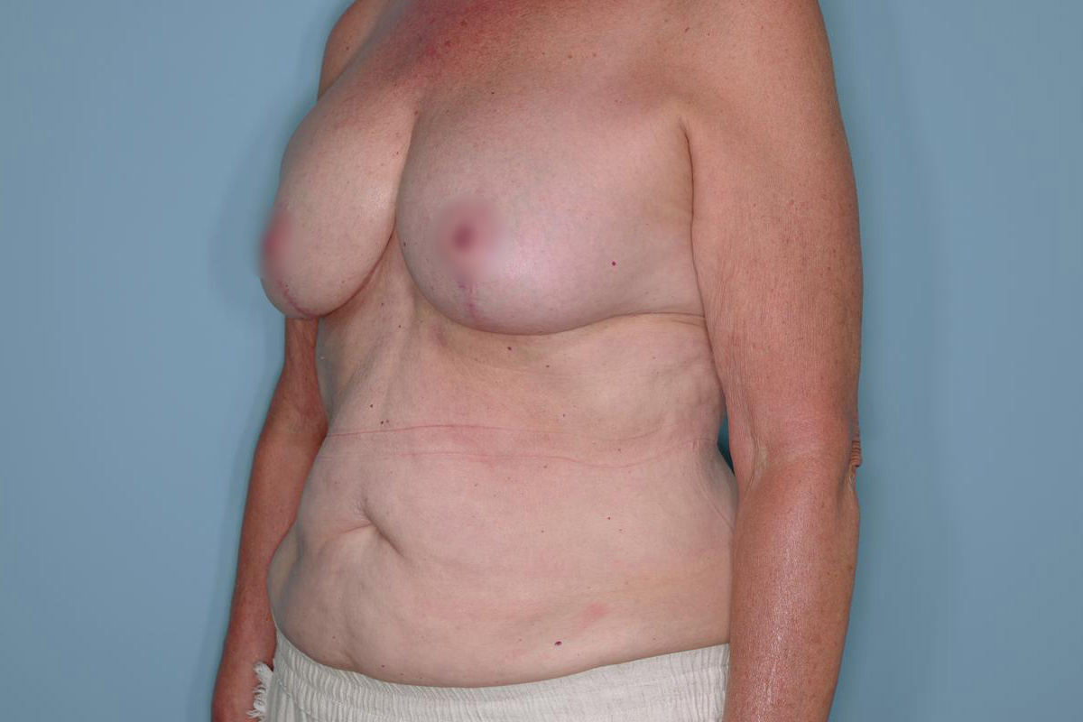 Implant Exchange Lift Before & After Patient #651