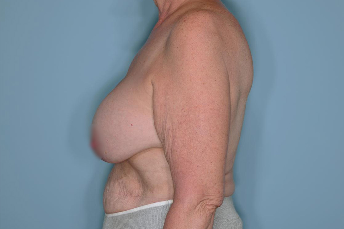Implant Exchange Lift Before & After Patient #651