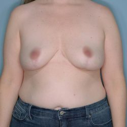 Implant Removal Lift Before & After Patient #652