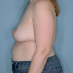 Implant Removal Lift Before & After Patient #652