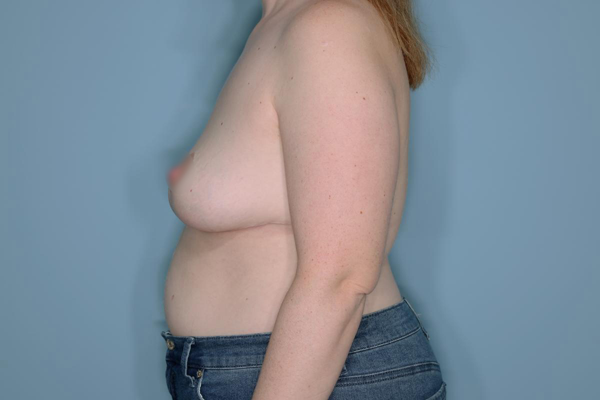 Implant Removal Lift Before & After Patient #652