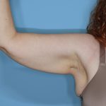 Liposuction and Renuvion J Plasma Before & After Patient #654
