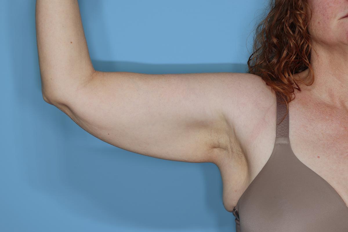 Liposuction and Renuvion J Plasma Before & After Patient #654