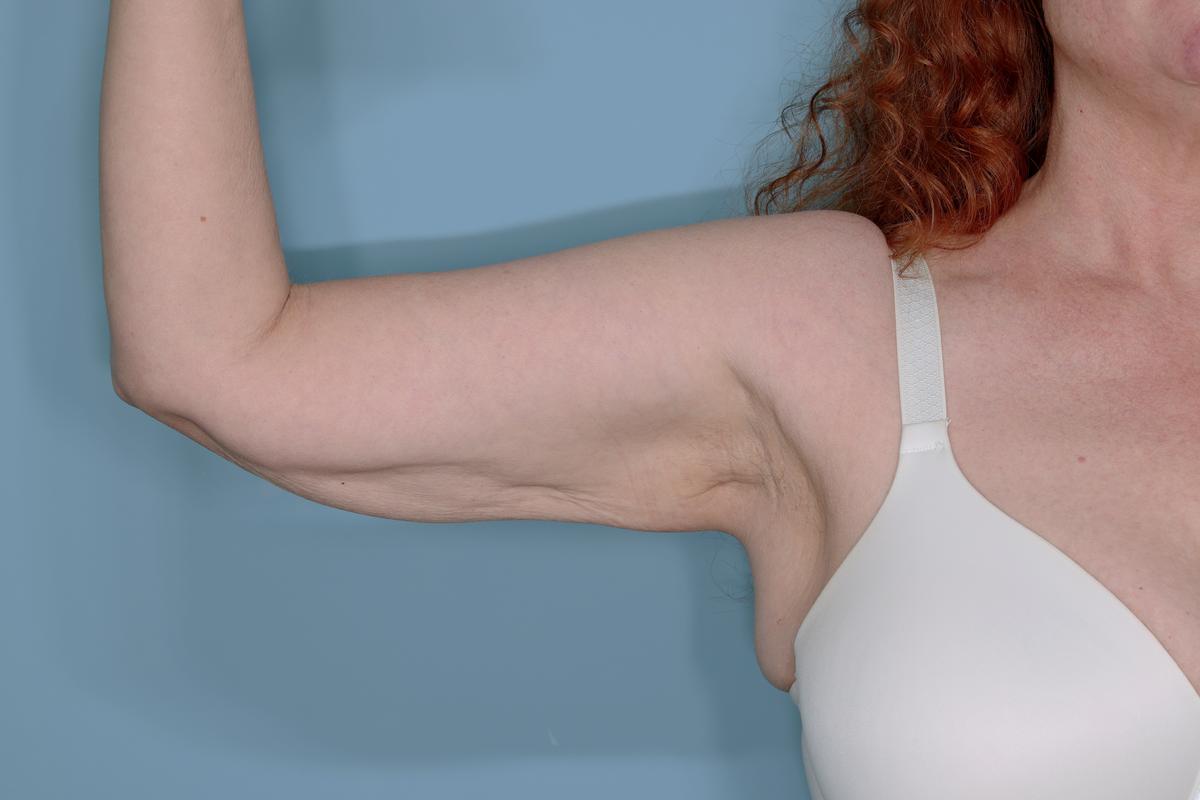 Liposuction and Renuvion J Plasma Before & After Patient #654