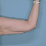 Liposuction and Renuvion J Plasma Before & After Patient #654