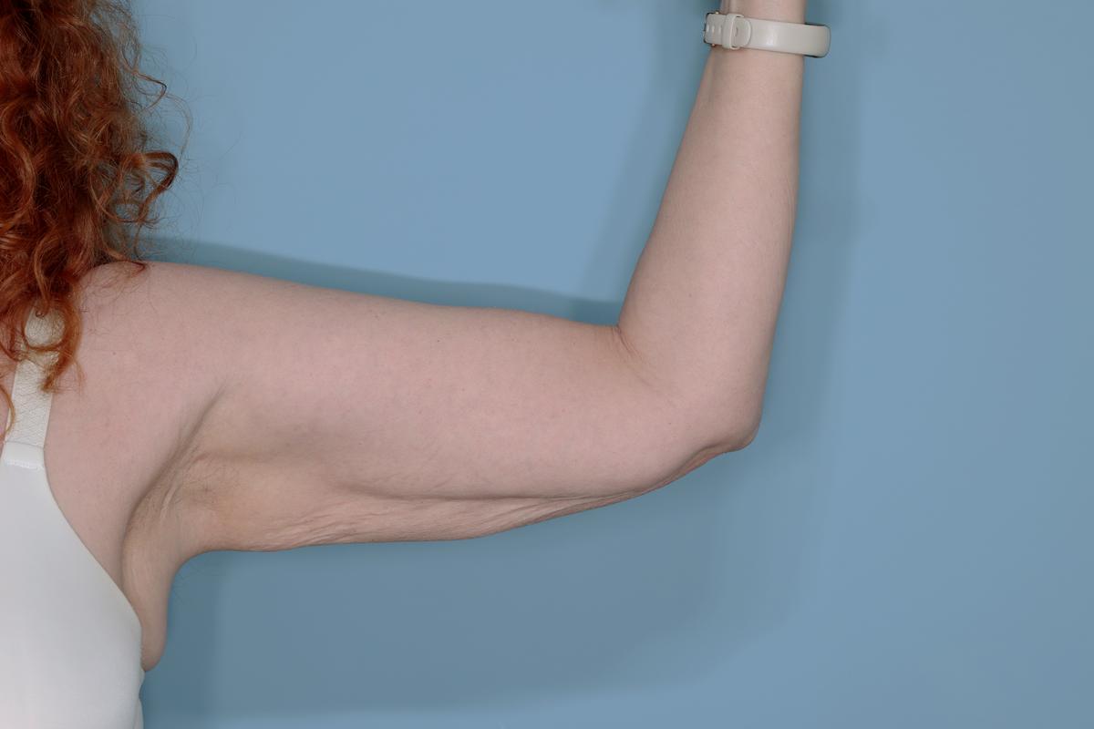 Liposuction and Renuvion J Plasma Before & After Patient #654