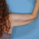Liposuction and Renuvion J Plasma Before & After Patient #654