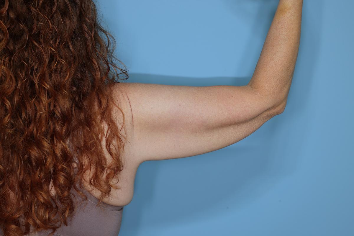 Liposuction and Renuvion J Plasma Before & After Patient #654