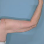 Liposuction and Renuvion J Plasma Before & After Patient #654