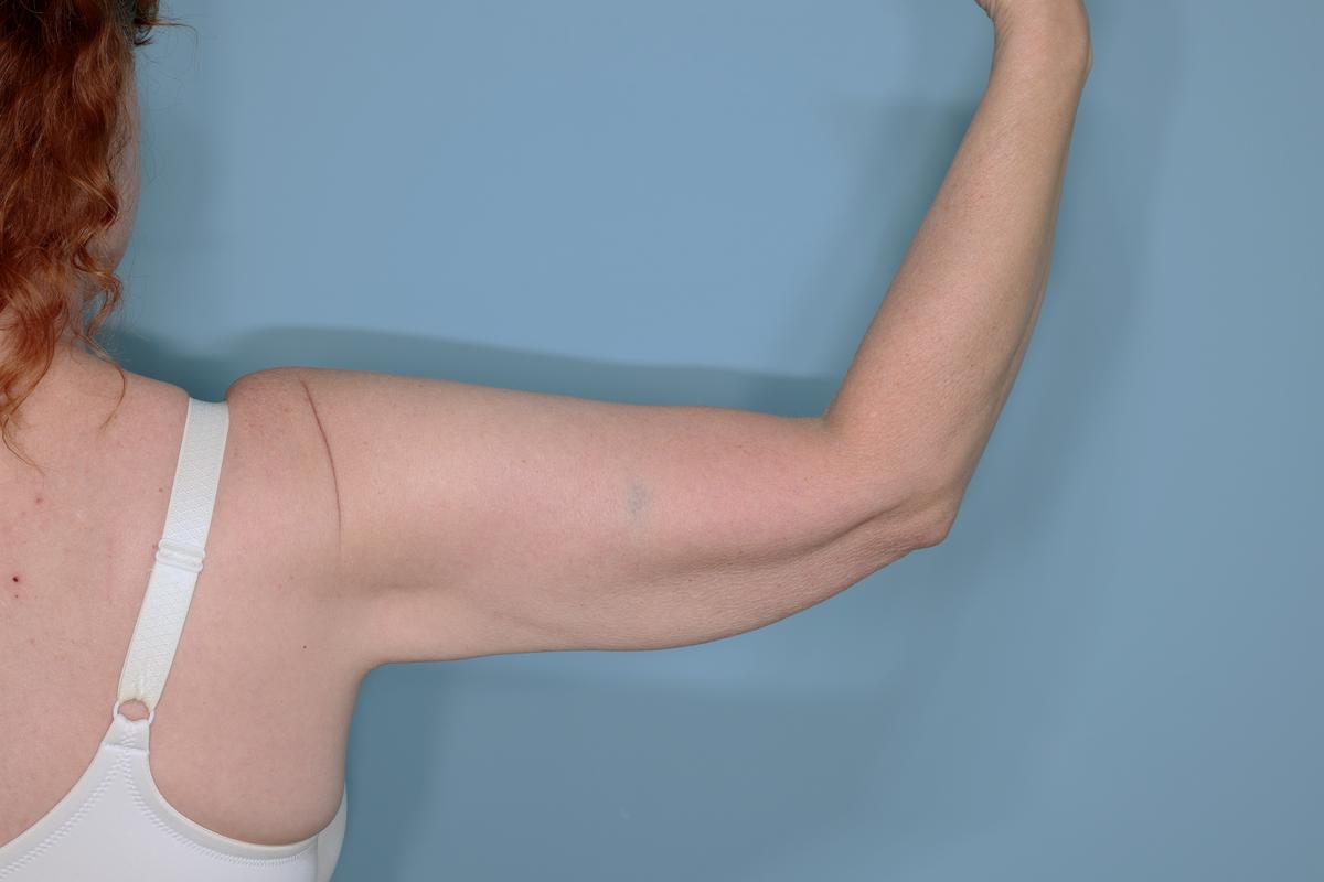 Liposuction and Renuvion J Plasma Before & After Patient #654