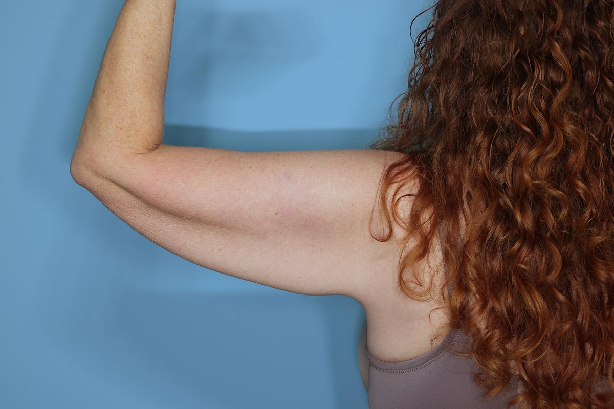 Liposuction and Renuvion J Plasma Before & After Patient #654