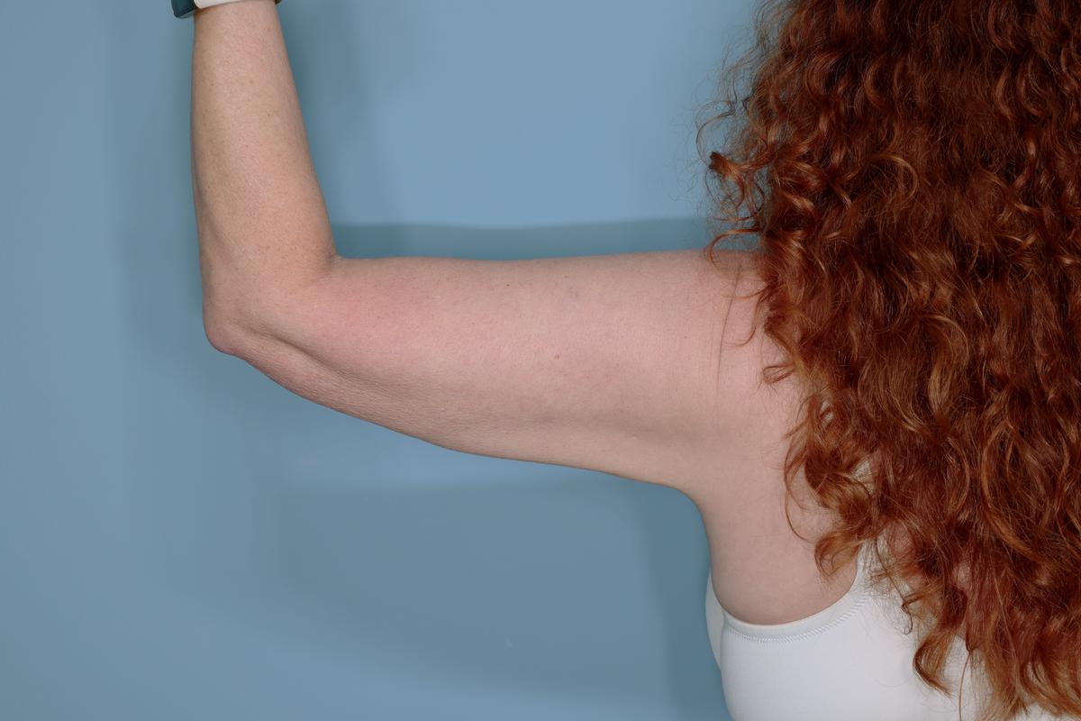 Liposuction and Renuvion J Plasma Before & After Patient #654