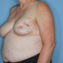 Breast Reconstruction Before & After Patient #593