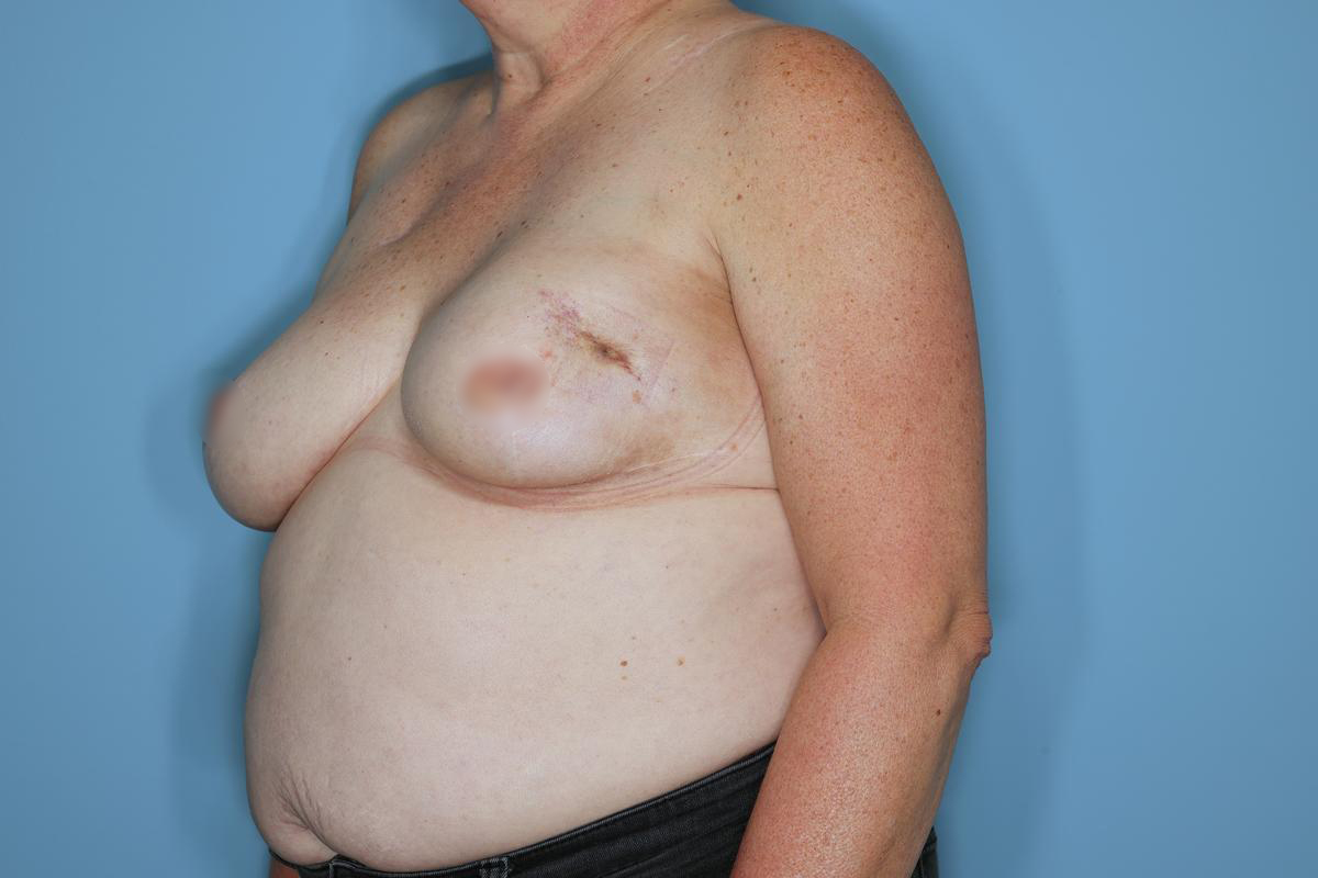 Breast Reconstruction Before & After Patient #593