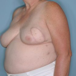 Breast Reconstruction Before & After Patient #593