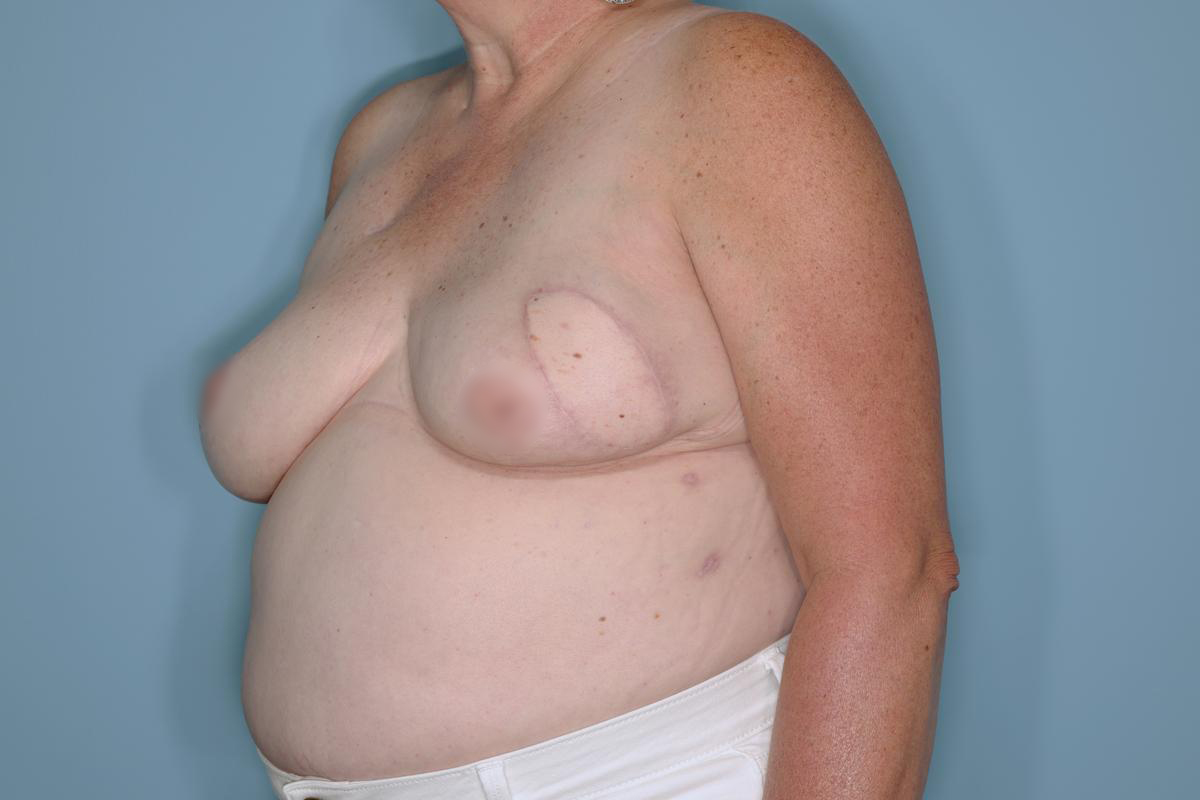 Breast Reconstruction Before & After Patient #593