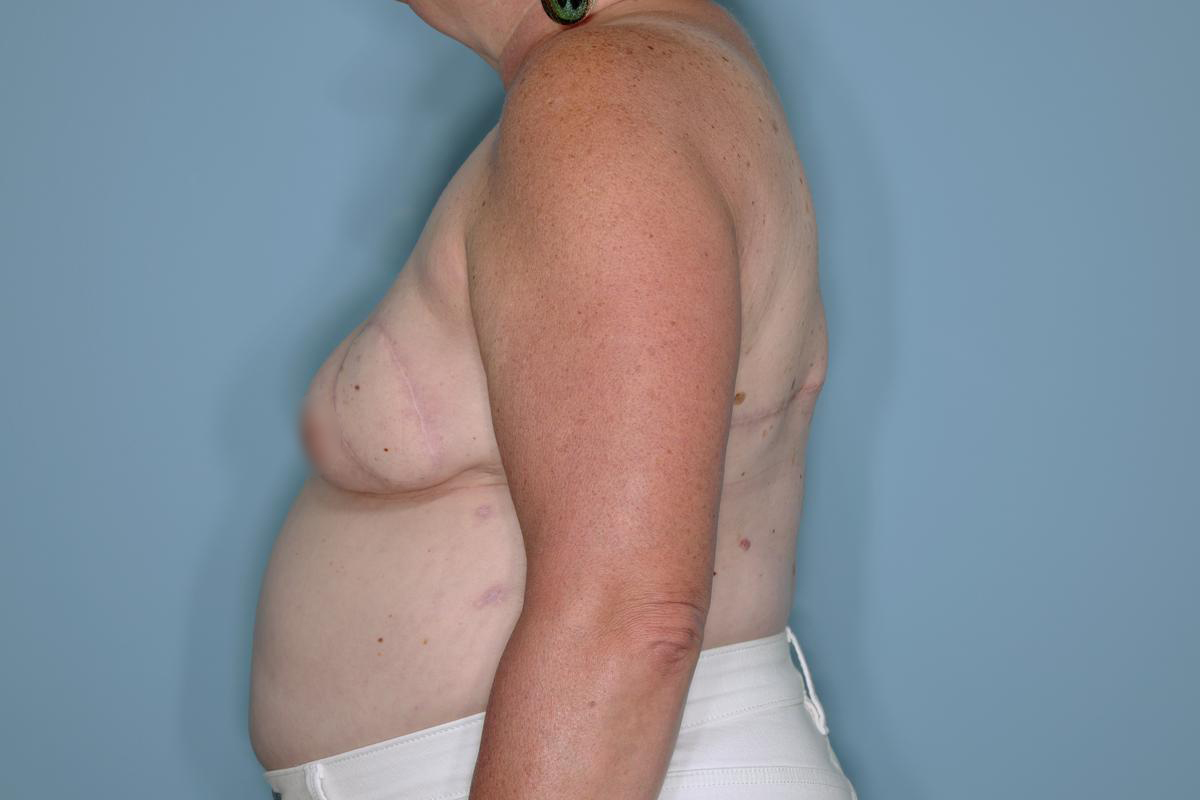 Breast Reconstruction Before & After Patient #593