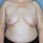 Oncoplastic Reduction Before & After Patient #655