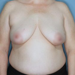 Oncoplastic Reduction Before & After Patient #655