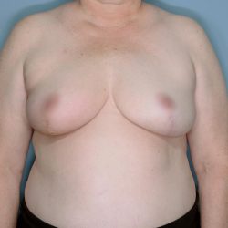 Oncoplastic Reduction Before & After Patient #655