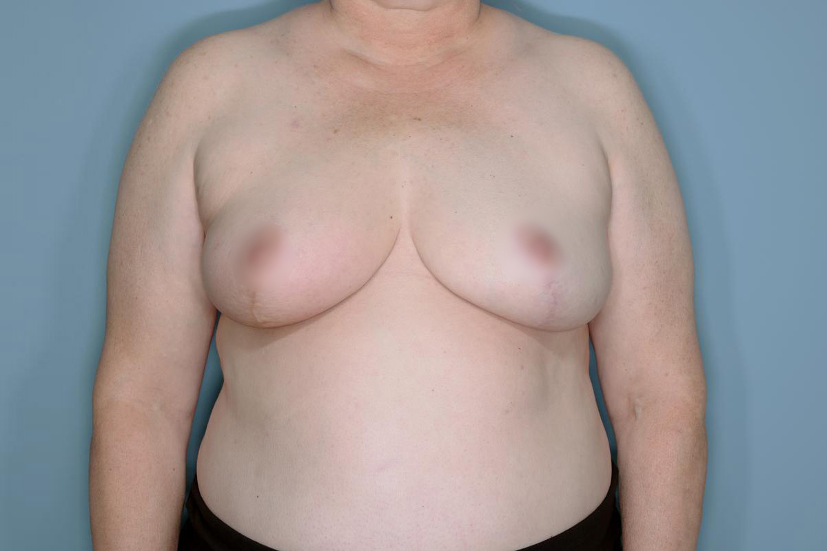 Oncoplastic Reduction Before & After Patient #655