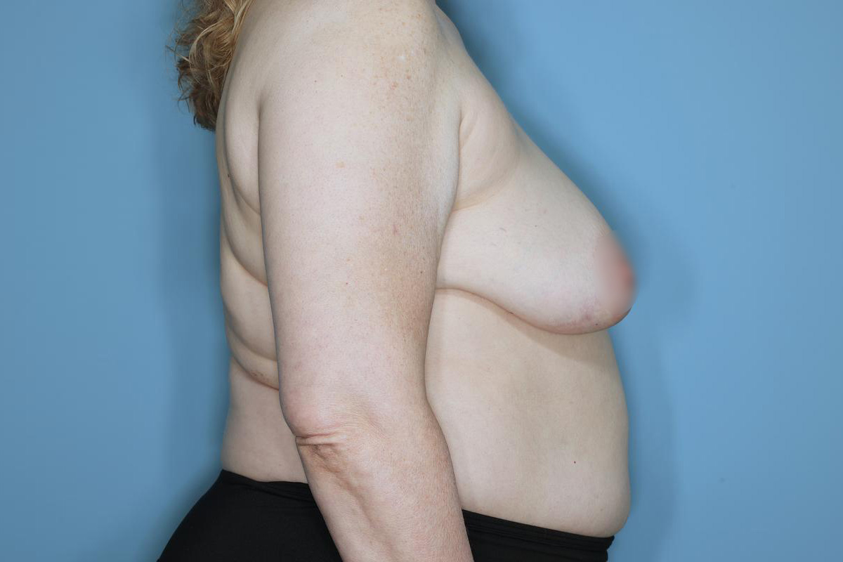 Oncoplastic Reduction Before & After Patient #655