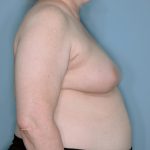 Oncoplastic Reduction Before & After Patient #655