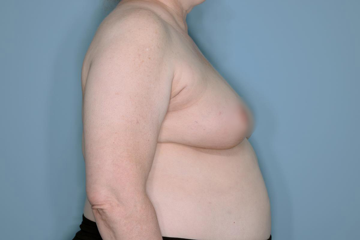Oncoplastic Reduction Before & After Patient #655