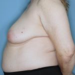 Oncoplastic Reduction Before & After Patient #655