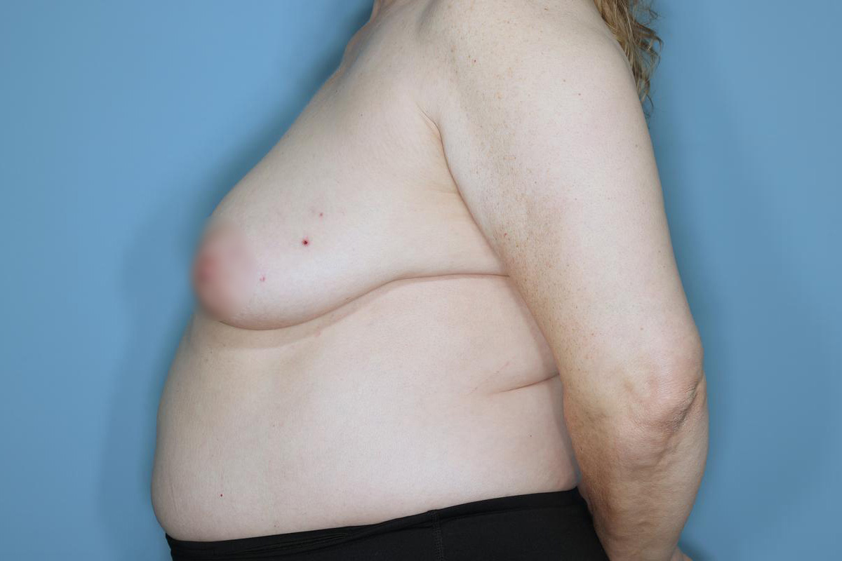 Oncoplastic Reduction Before & After Patient #655