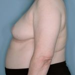 Oncoplastic Reduction Before & After Patient #655