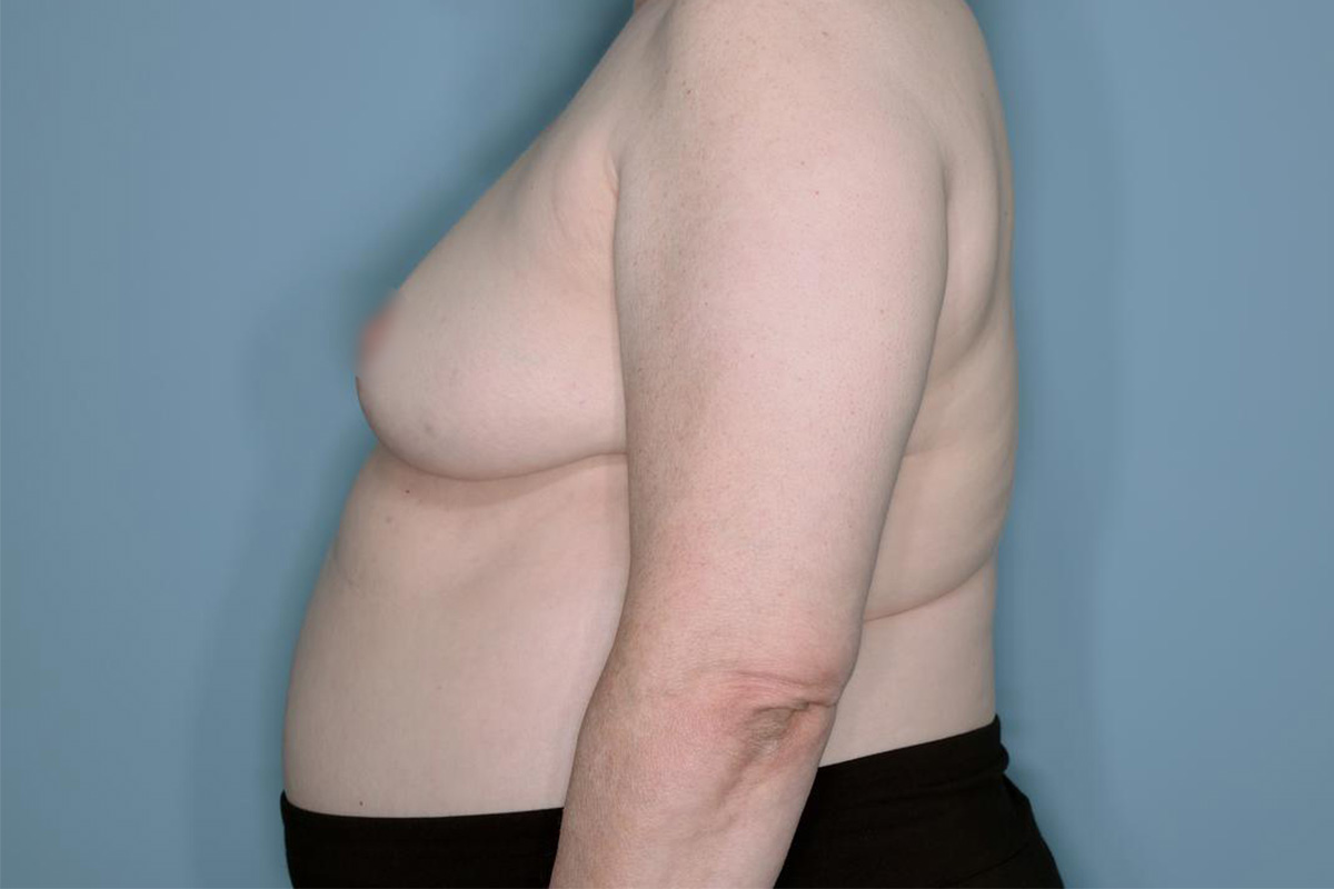 Oncoplastic Reduction Before & After Patient #655