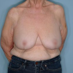 Oncoplastic Reduction Before & After Patient #595
