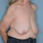 Oncoplastic Reduction Before & After Patient #595