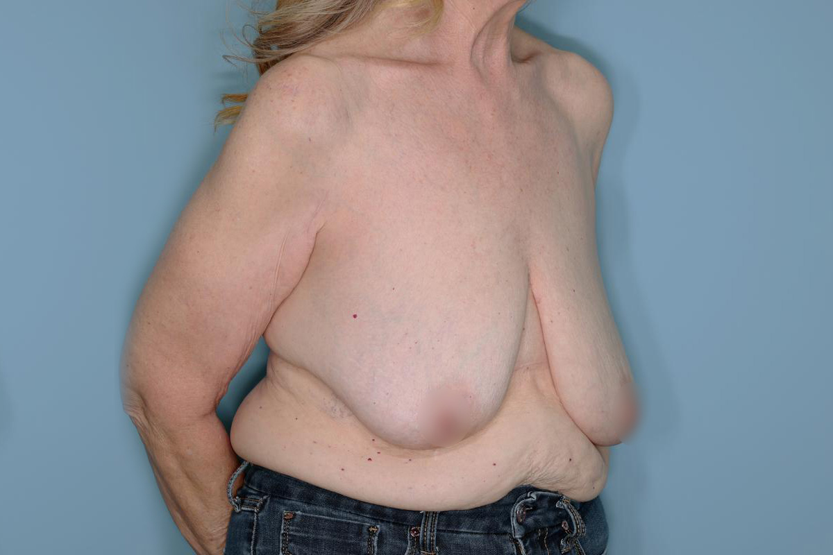 Oncoplastic Reduction Before & After Patient #595
