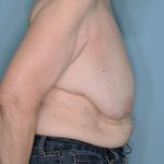 Oncoplastic Reduction Before & After Patient #595