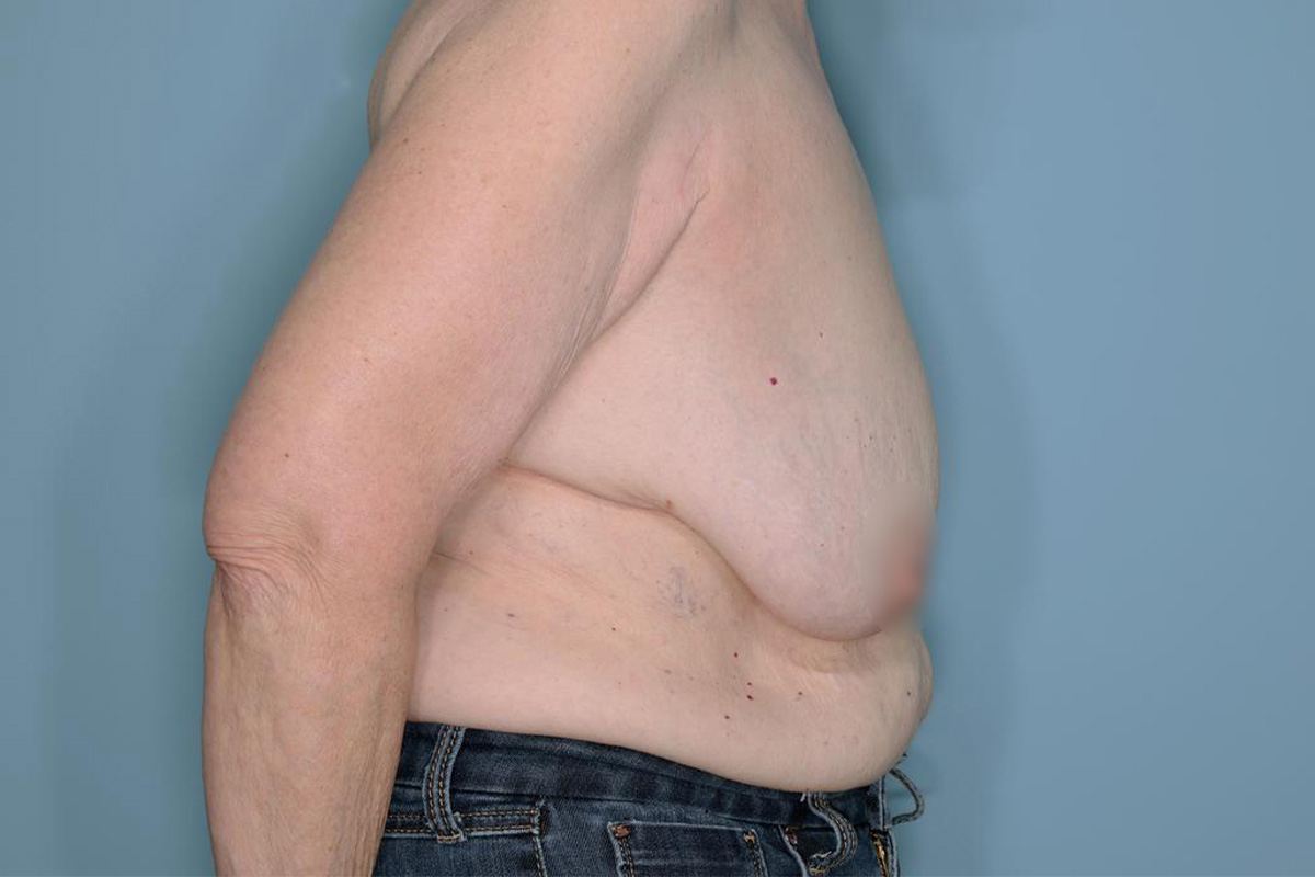 Oncoplastic Reduction Before & After Patient #595
