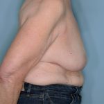 Oncoplastic Reduction Before & After Patient #595