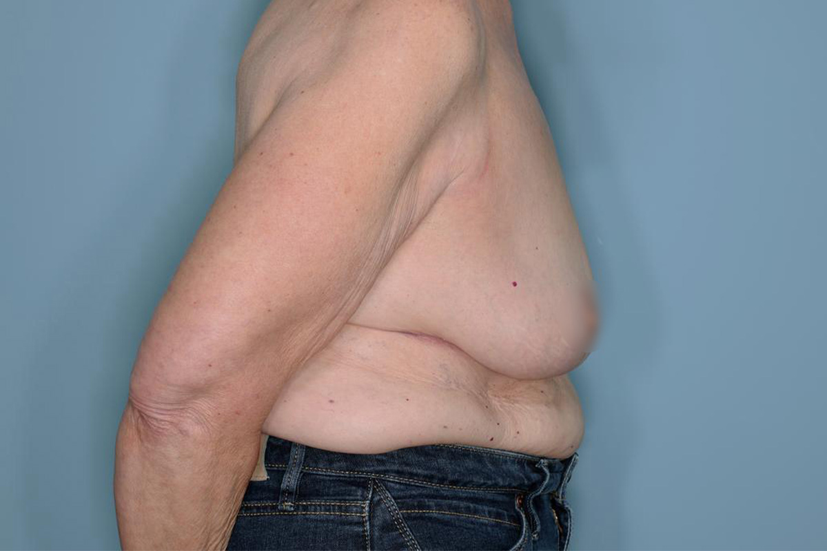Oncoplastic Reduction Before & After Patient #595