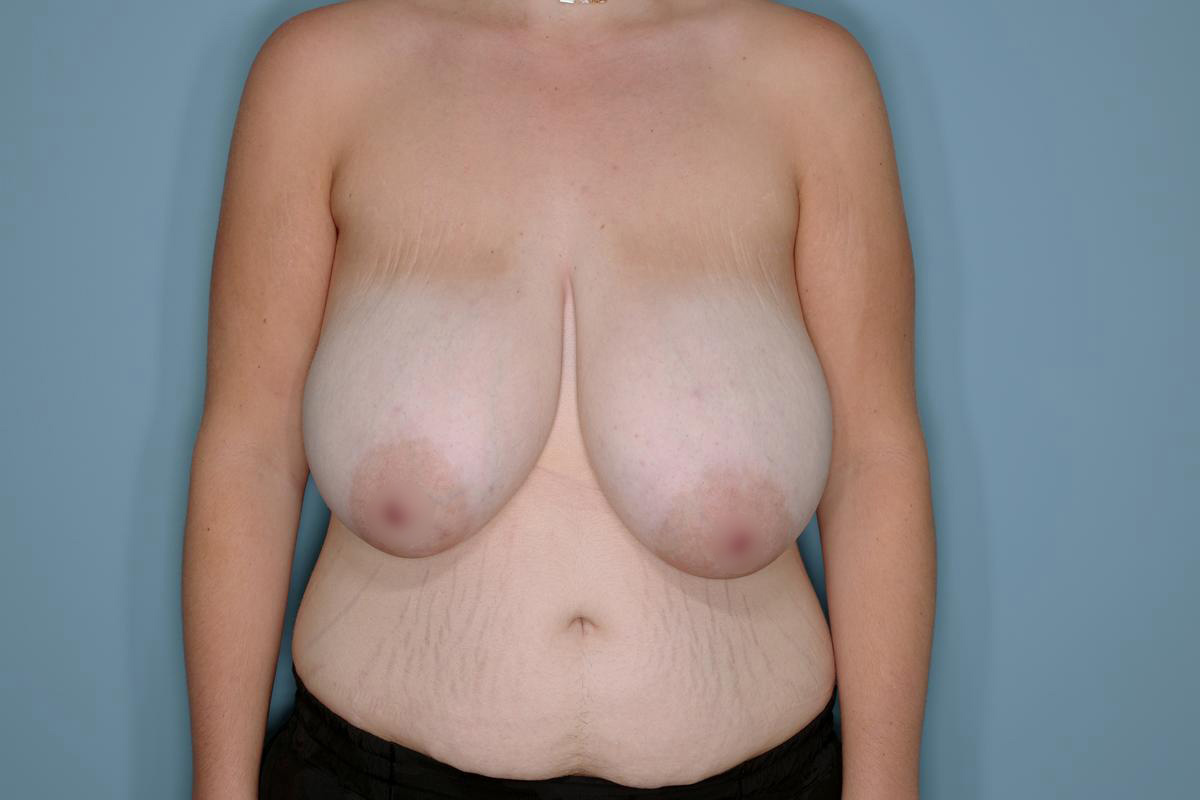 Breast Reduction Before & After Patient #594