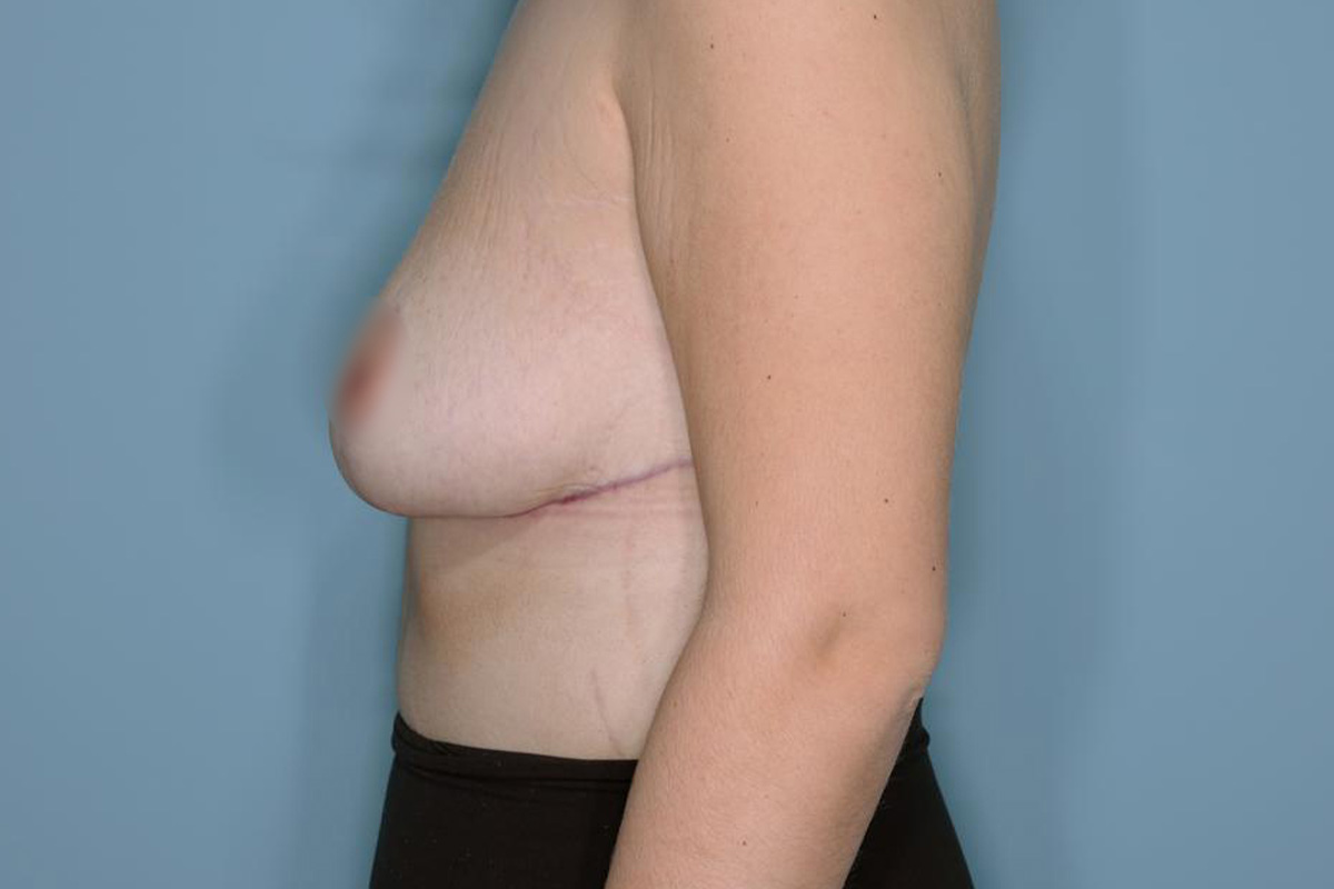 Breast Reduction Before & After Patient #594