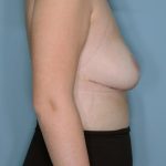 Breast Reduction Before & After Patient #594