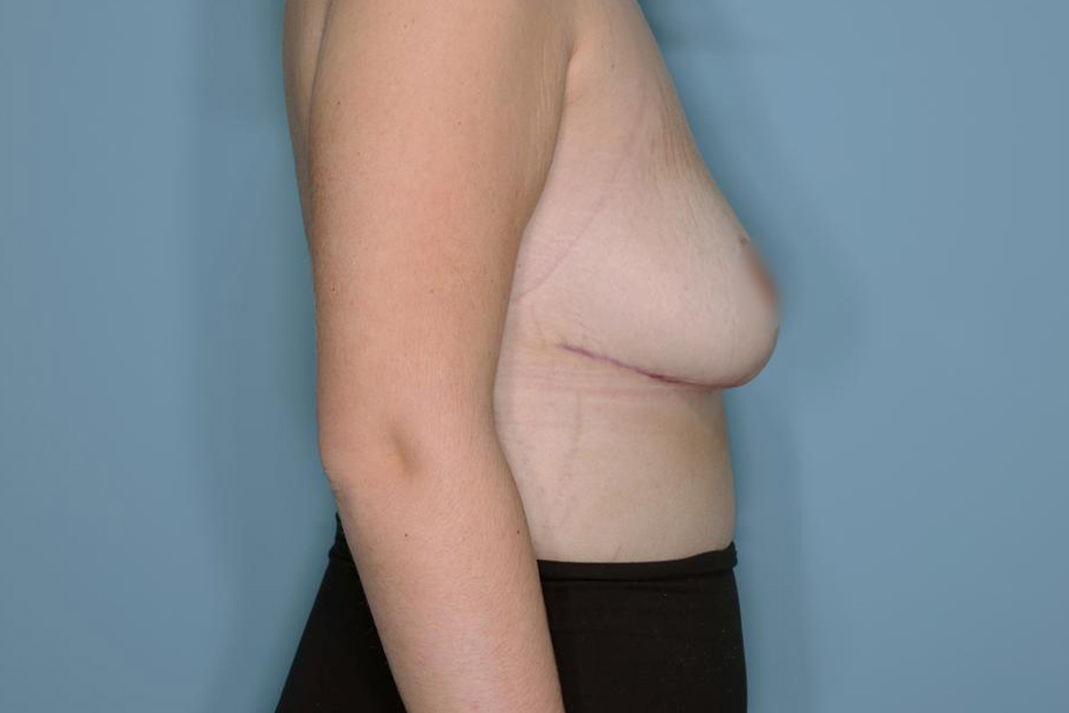 Breast Reduction Before & After Patient #594