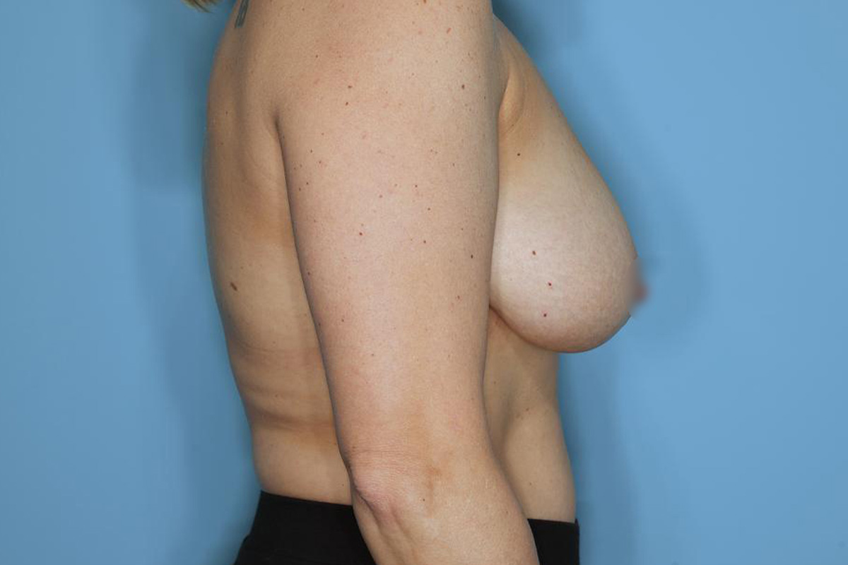 Breast Reduction Before & After Patient #716