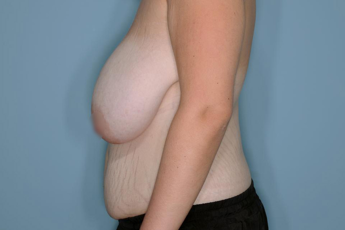 Breast Reduction Before & After Patient #594