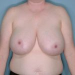 Breast Reduction Before & After Patient #650