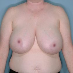 Breast Reduction Before & After Patient #650